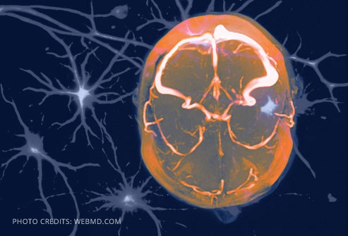 migraine-brain.jpg migraine-brain.jpg